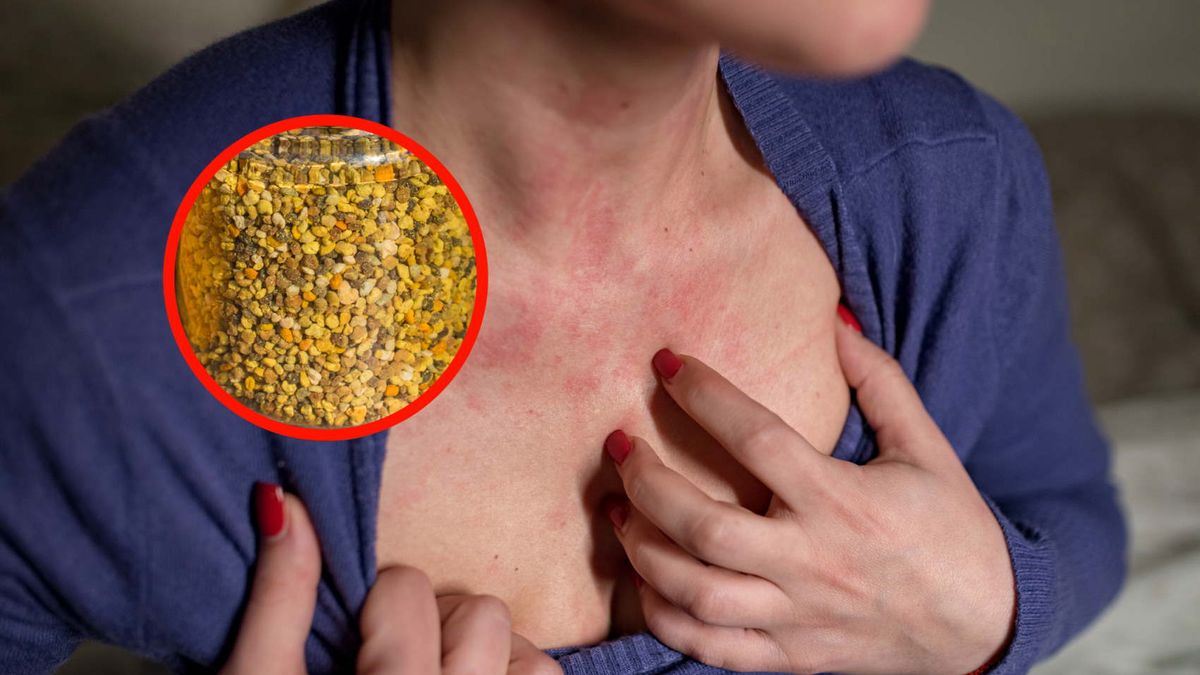 Znak, że organizm zaatakowały pasożyty lub grzyby. Włącz do diety, by szybko się z nimi uporać