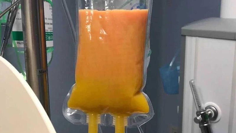Tłuszcz z przefiltrowanej krwi kobiety