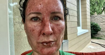 Była syrenka Stephanie Huff ma raka skóry. "Leżeliśmy na folii aluminiowej"