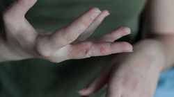 Świerzbowiec ludzki — jak go rozpoznać i się pozbyć?