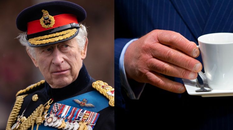 "Kiełbasiane palce" Karola mogą być wynikiem choroby