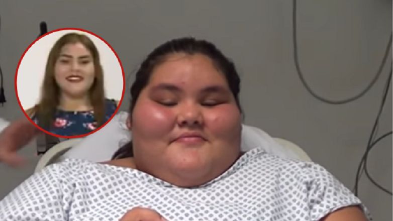 Dziewczynka musiała przejść operację zmniejszenia żołądka