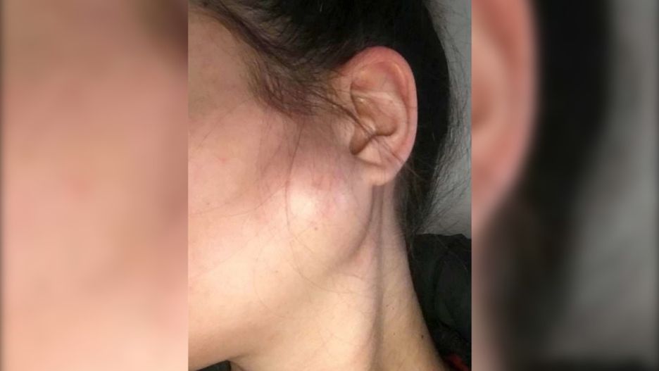 Kate choruje na raka ślinianki