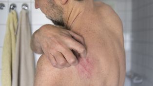 Pierwsza taka terapia. FDA zatwierdziła przełomowy lek na łuszczycowe zapalenie stawów