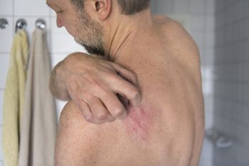 Pierwsza taka terapia. FDA zatwierdziła przełomowy lek na łuszczycowe zapalenie stawów