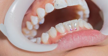 Biżuteria nazębna a zdrowie. To mówią dentyści