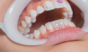 Biżuteria nazębna a zdrowie. To mówią dentyści