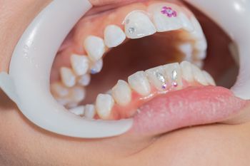 Biżuteria nazębna a zdrowie. To mówią dentyści