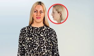 "Byłam gnębiona przez nos". Operacja zmieniła jej życie