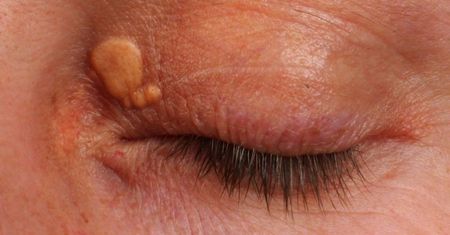 Problem 21 mln Polaków. Objawy wysokiego cholesterolu możesz zauważyć na twarzy