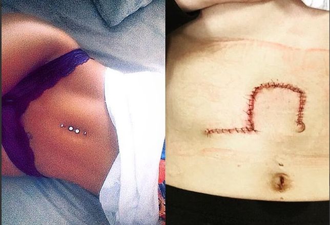 Teraz Cloe przestrzega innych przed chorobą