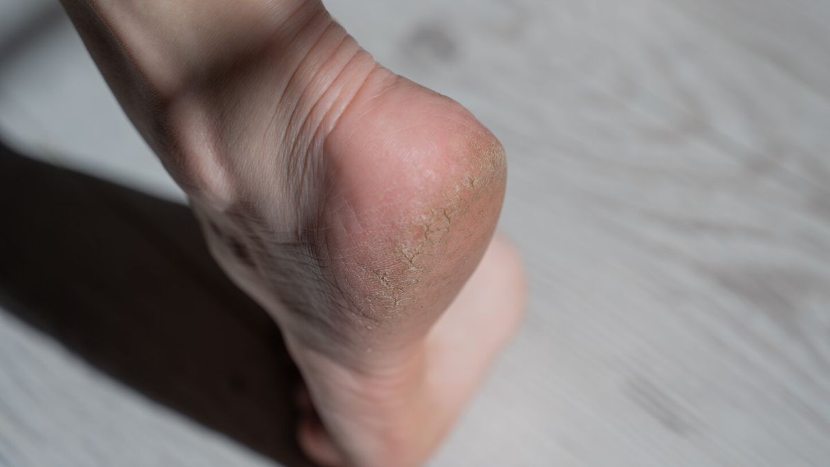 Te choroby rozpoznasz po stanie paznokci. Obserwuj zmiany