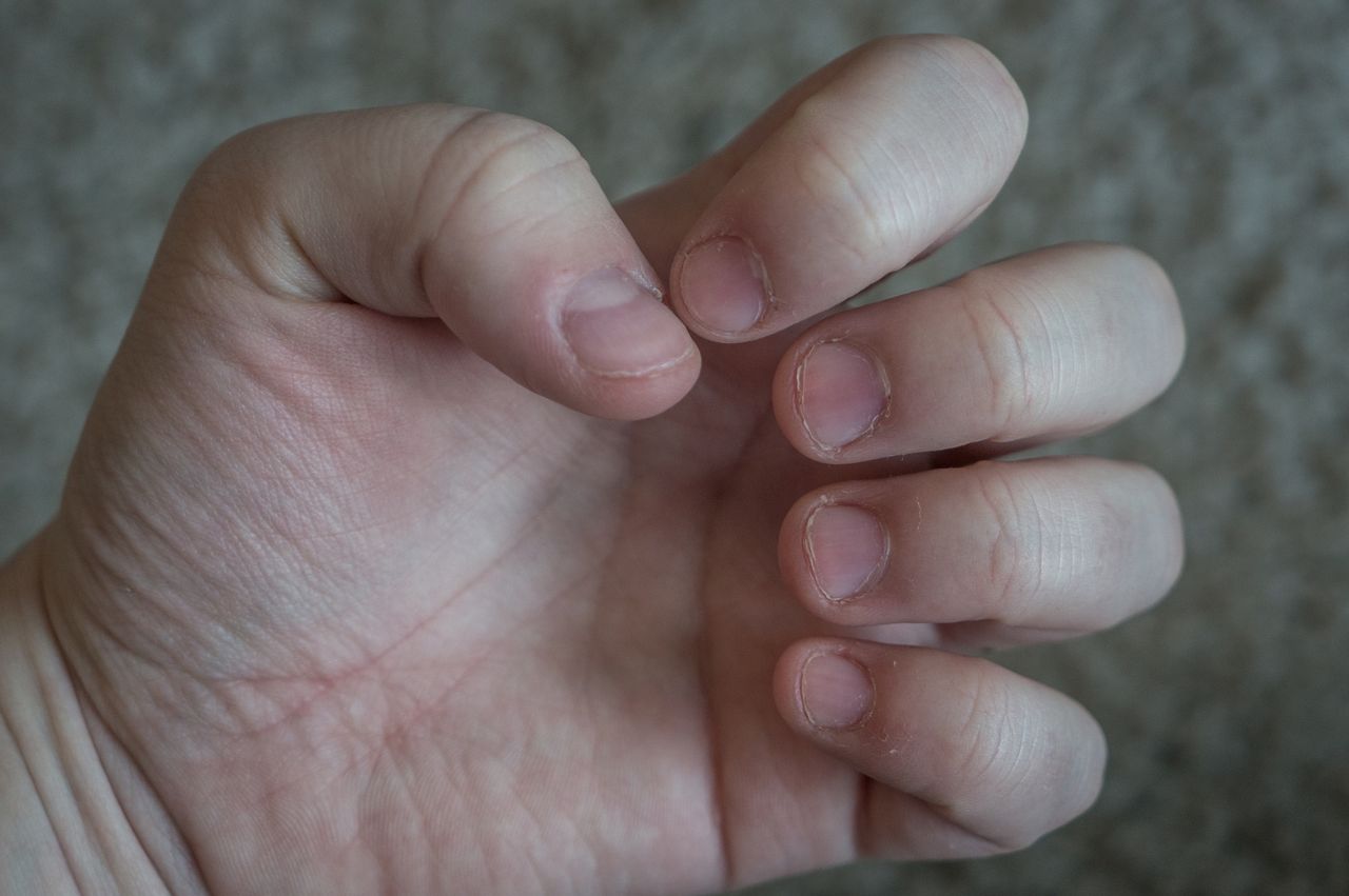 Could your nails signal liver disease? Tracing hidden symptoms on your ...