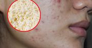 Tortury dla skóry. To dlatego masz problem z wągrami i wypryskami