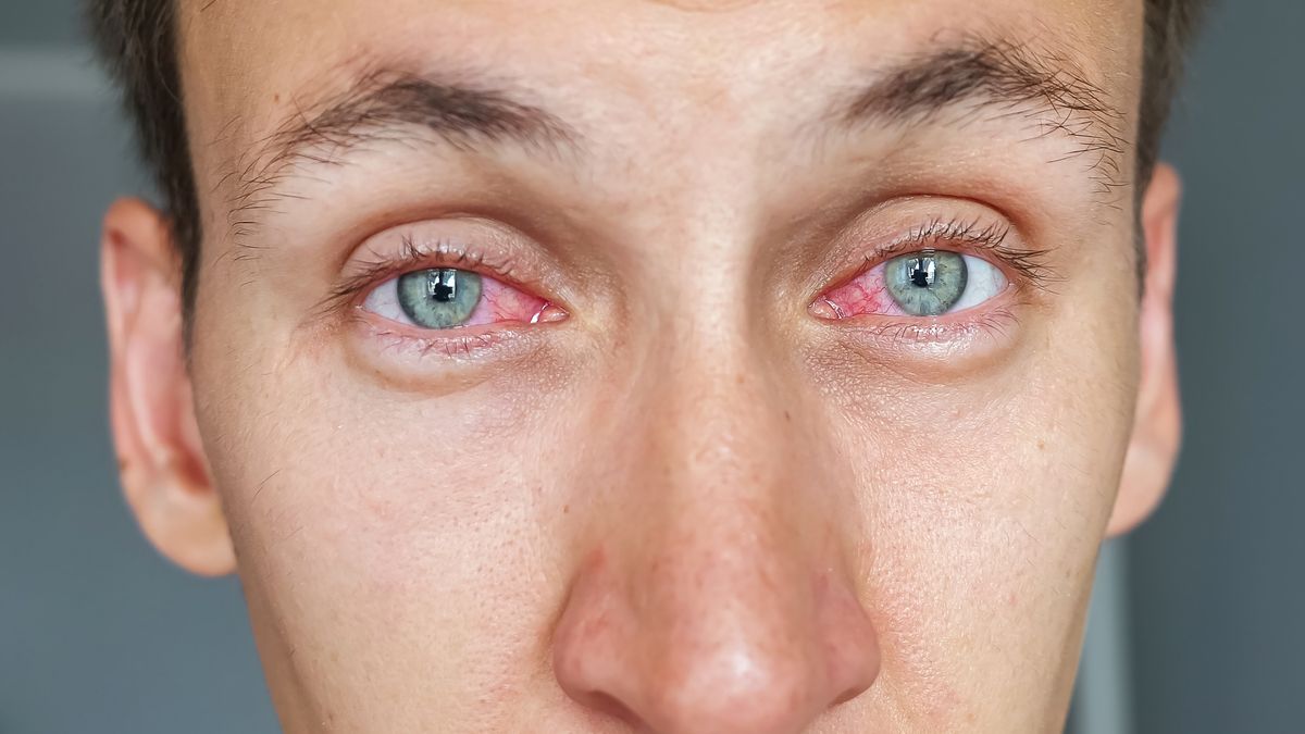 Przekrwione oczy mogą być objawem choroby