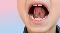 Owrzodzenie jamy ustnej - przyczyny, objawy i leczenie