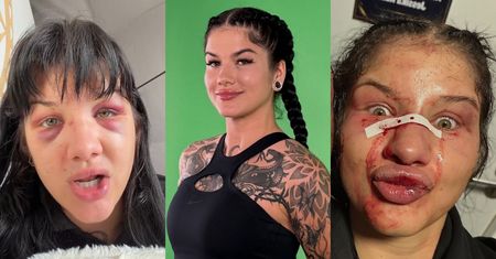 Dominika Rybak pokazała złamany nos i PODBITE OCZY po przegranej walce: "Wk*rwia mnie ograniczone pole widzenia" (FOTO)