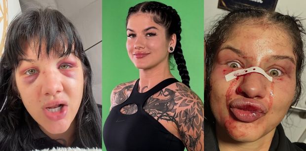 Dominika Rybak pokazała złamany nos i PODBITE OCZY po przegranej walce: "Wk*rwia mnie ograniczone pole widzenia" (FOTO)
