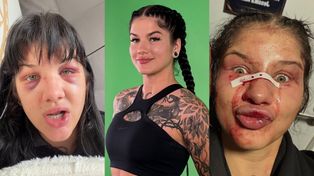 Dominika Rybak pokazała złamany nos i PODBITE OCZY po przegranej walce: "Wk*rwia mnie ograniczone pole widzenia" (FOTO)