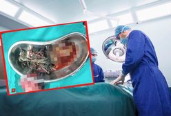 Bolał go brzuch. Lekarze osłupieli. Znaleźli 60 przedmiotów w mężczyźnie