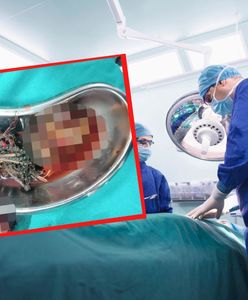 Bolał go brzuch. Lekarze osłupieli. Znaleźli 60 przedmiotów w mężczyźnie