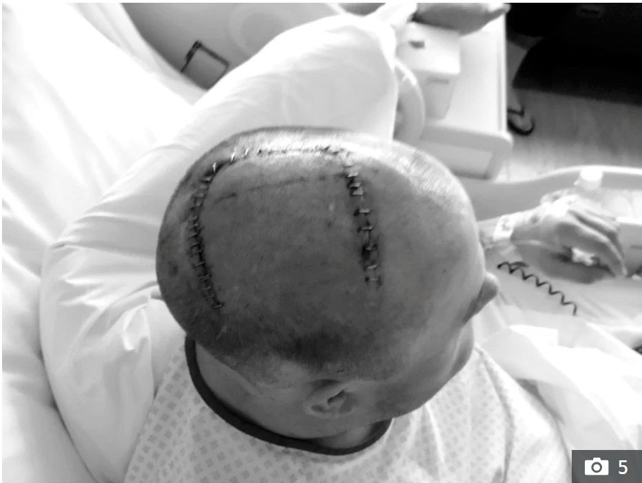 Szwy po operacji guza