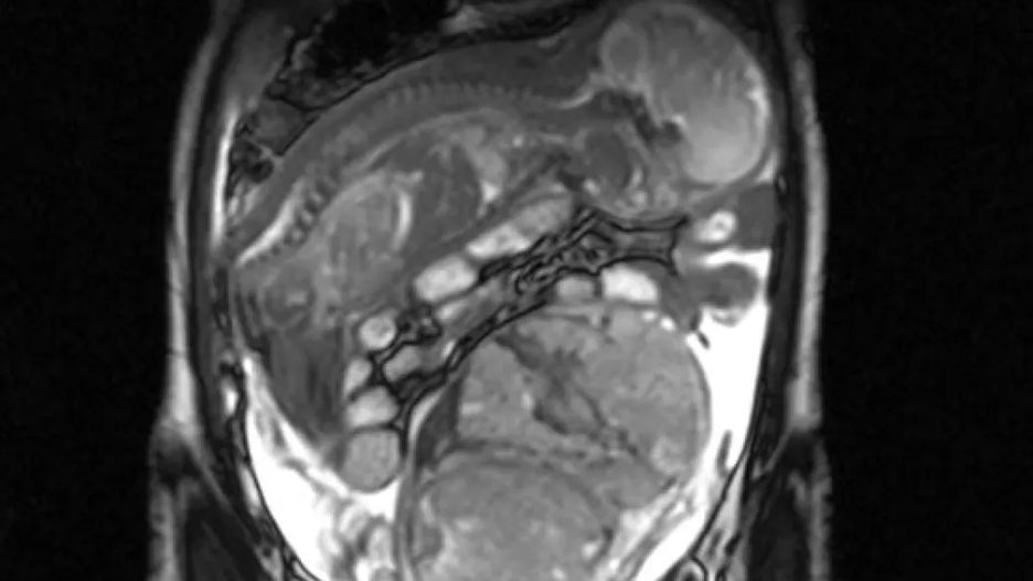 Przeprowadziła domową aborcję. Po badaniu lekarze przeżyli szok