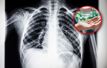 Tanie suplementy mogą wspierać płuca. Naukowcy zauważyli ciekawą zależność
