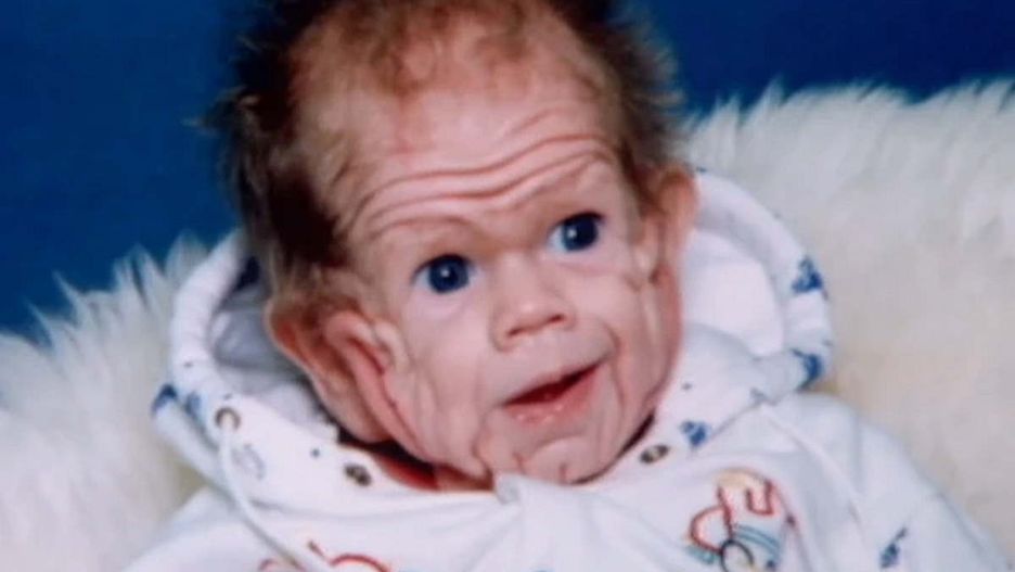 Noworodek o wyglądzie staruszka. Rodzice byli w szoku, gdy go zobaczyli