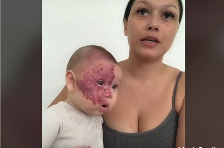 Mama nazwana „potworem” za to, że zdecydowała się na laserowe usunięcie znamienia na twarzy dziecka