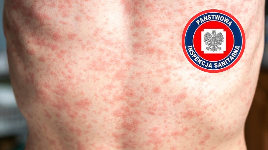 Odra znów atakuje. Ognisko choroby w trzech powiatach Podkarpacia