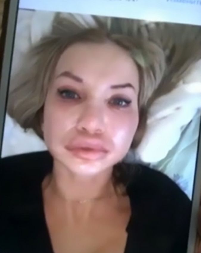 Powiększyła usta w domu. Efekt jest przerażający (WIDEO)