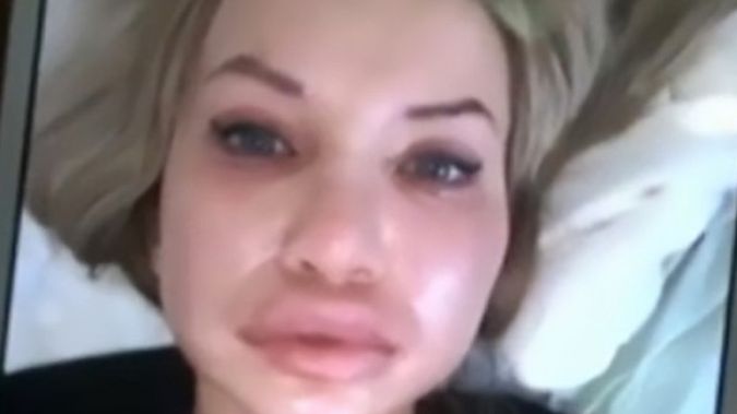  Powiększenie ust jest popularnym zabiegiem