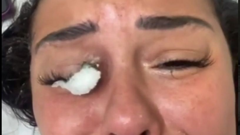 Chciała przedłużyć rzęsy. Kosmetyczka uszkodziła jej oko do tego stopnia, że omal nie straciła wzroku