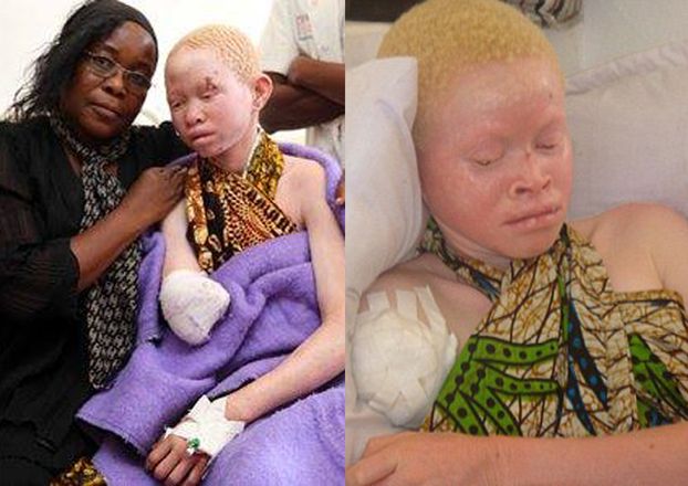 Albinosi w Tanzanii są mordowani na... amulety! (UWAGA: DRASTYCZNE ZDJĘCIA)