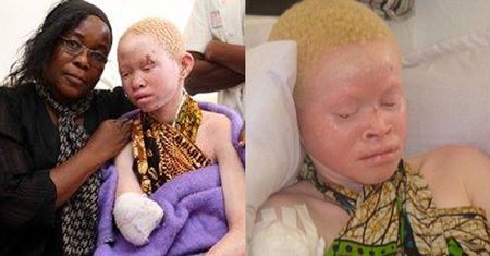 Albinosi w Tanzanii są mordowani na... amulety! (UWAGA: DRASTYCZNE ZDJĘCIA)