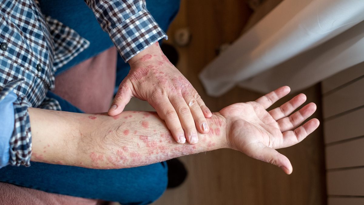 Dermatolog o ukrytych skutkach chorób skóry