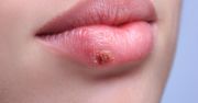 Jak leczyć opryszczkę?
