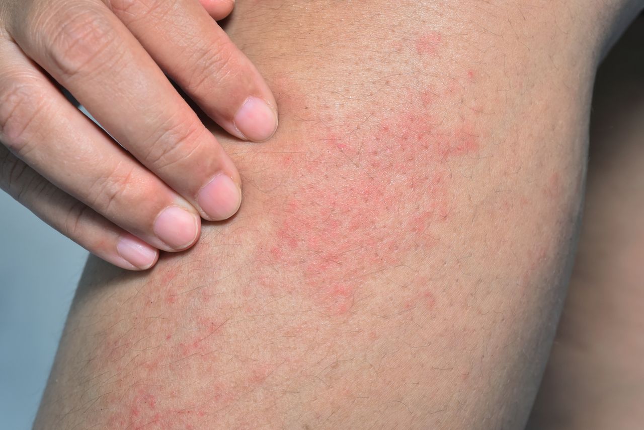 Swędzenie skóry – co może oznaczać? Jak łagodzić nieprzyjemny świąd?