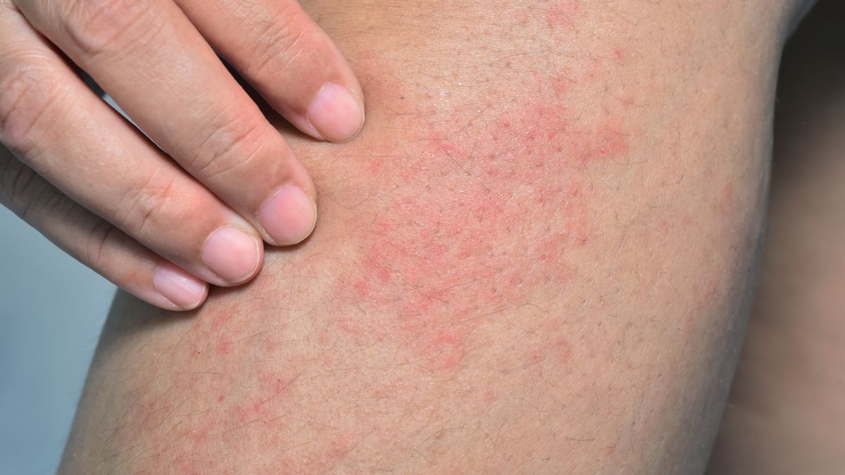 Swędzenie skóry wymusza częste drapanie