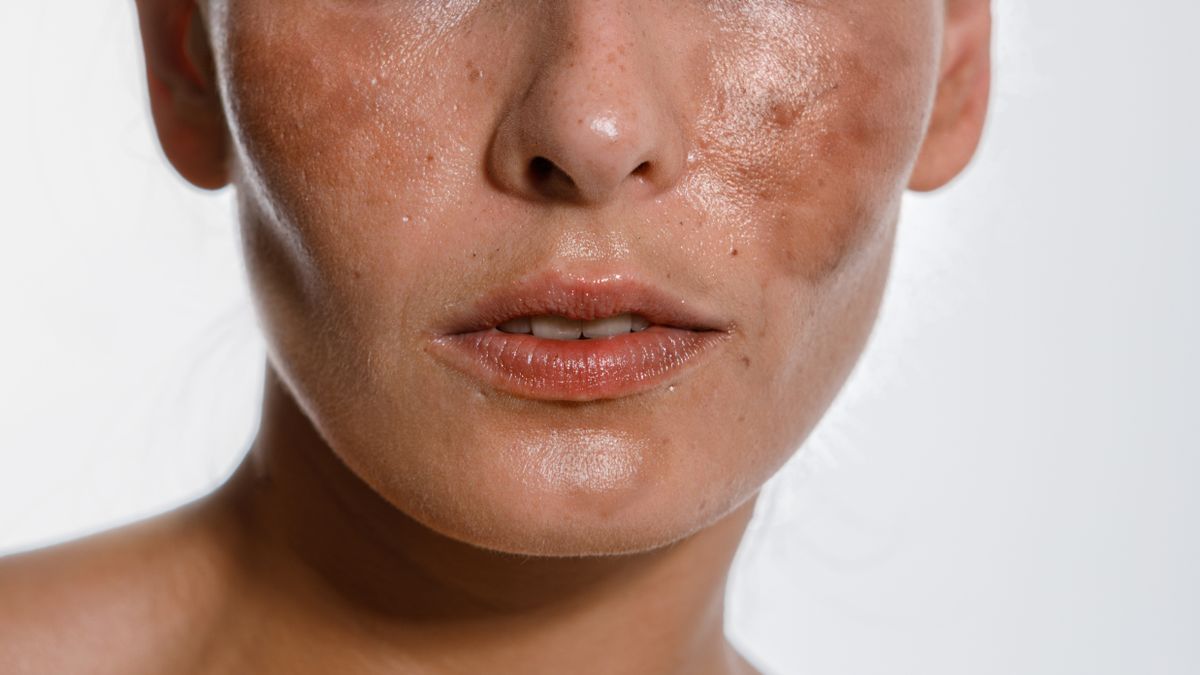 Przebarwienia skóry są powszechnym problemem dermatologicznym.