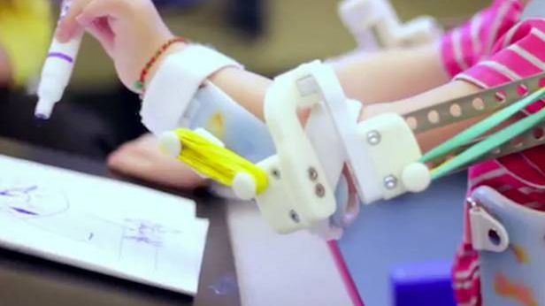 Drukowany egzoszkielet odmienił życie 2-letniej dziewczynki 1