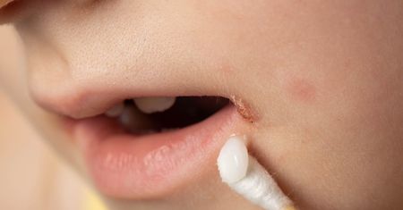 Liszaj u dziecka – przyczyny, objawy, domowe sposoby i leczenie