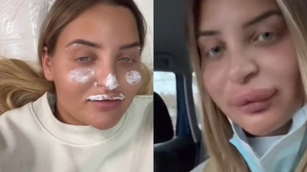23-latka pokazała zabieg usuwający wypełniacze do ust
