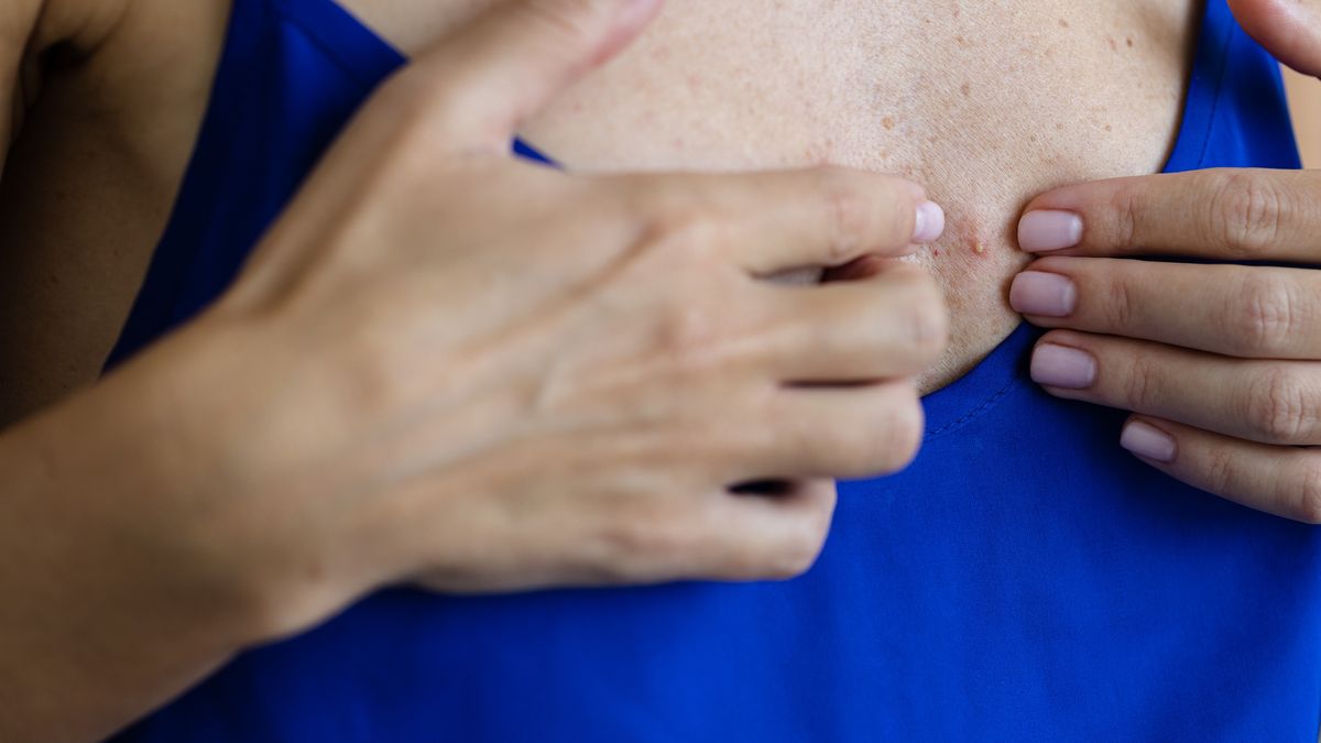 Girl squeezes pimple on her chest. Closeup. Healthcare and medicine concept.
Girl squeezes pimple on her chest. Closeup. Selective focus. Healthcare and medicine concept.
Vitalina Nakonechna
healthcare