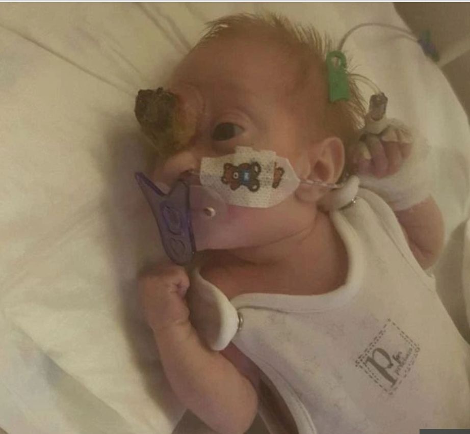 Dziewczynka z przepukliną mózgową