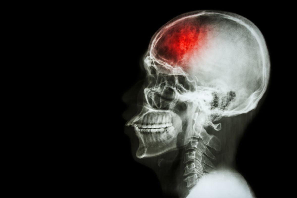 Udar mózgu często kończy fatalnie. Jak go uniknąć?