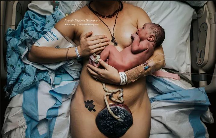 Łożysko w trakcie porodu