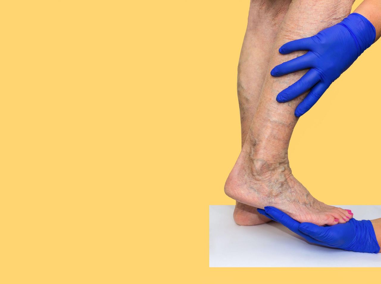 Pajączki na nogach - przyczyny, objawy i leczenie. Domowe sposoby na pękające naczynka