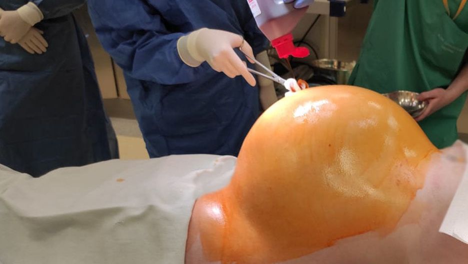 Pacjentka z Krosna miała 30-kilogramowy guz jajnika